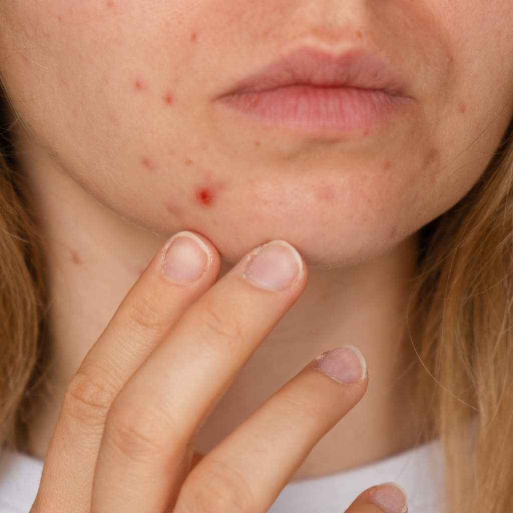 tratamento para acne e cicatrizes de acne